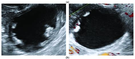 Ultrasound Features Of Borderline Ovarian Tumor Initially Classified As