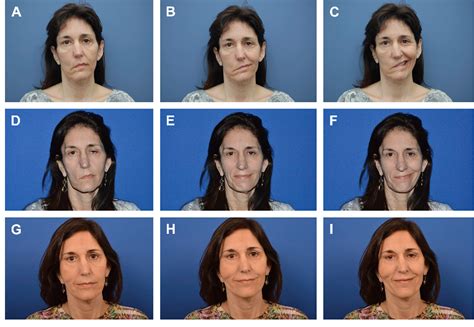 Figure 12 from The Gracilis Free Flap. | Semantic Scholar