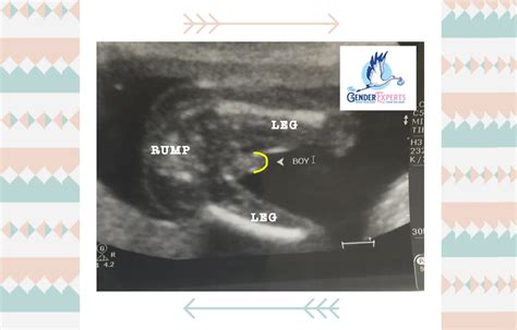 20 Week Fetus Ultrasound Gender