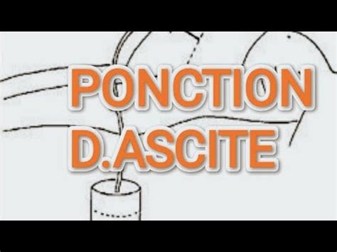 PRÉPARATION DU MATÉRIEL POUR UNE PONCTION D ASCITE YouTube