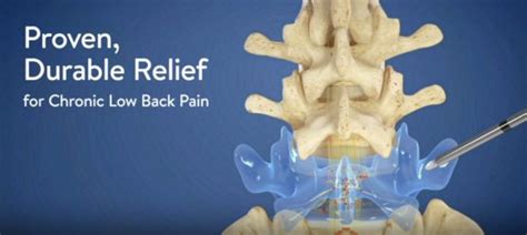 Intracept® Procedure for Chronic Lower Back Pain | DISC