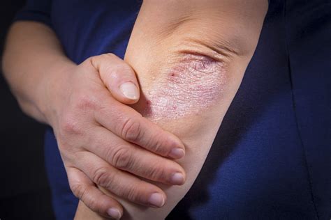 Treatments For Mild Psoriasis Psoriasis Cure Now