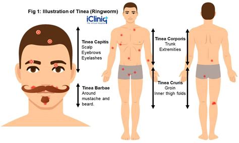 Dermatophyte Infection What Is It Causes Signs And