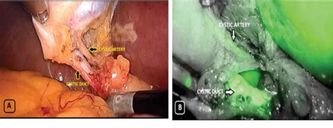 Figure From Intraoperative Visualization Of Biliary Anatomy Using