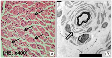 The Sural Nerve Biopsy Shows Large Number Of Onion Bulbs Arrows A