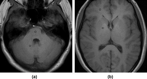 Gadolinium Deposition In The Brain Is Related To Various Contrast