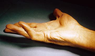 Palmar Fasciectomy New York Ny Handsport Surgery Institute