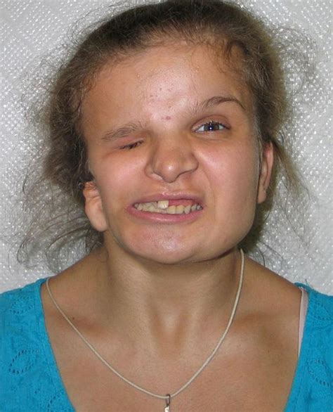 Latest Updates: Deformed teen who agreed to plastic surgery so mum would take her back dies