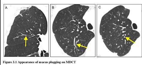 Figure 1.1 from An investigation of mucus plugging in severe asthma ...