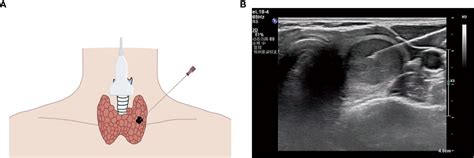 Frontiers Predictors And A Prediction Model For Positive Fine Needle Aspiration Biopsy In C