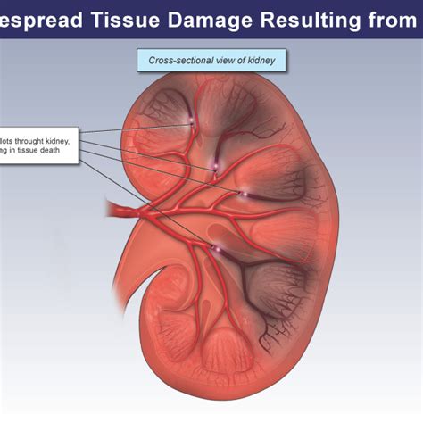 Umbilical Venous Catheter Uvc Placement Trial Exhibits Inc