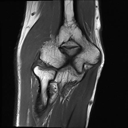 Elbow Synovial Fold Syndrome Image Radiopaedia Org