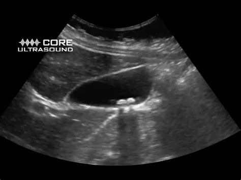 Gallbladder Ultrasound Stones