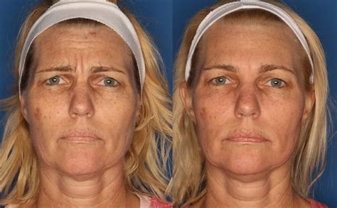 Patient Botox Dysport Xeomin Gallery Before After Photos