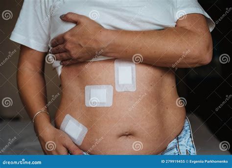 Laparoscopic Cholecystectomy Scars