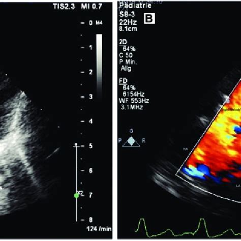 A Transthoracic Echocardiogram In The Subcostal Four Chamber View