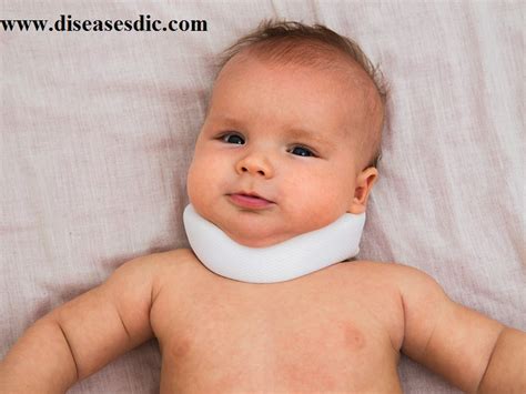 Torticollis - Definition, Symptoms and Treatment