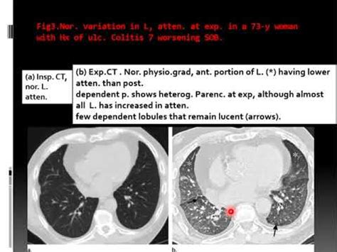 Mosiac Attenuation Of The Lung Part Youtube