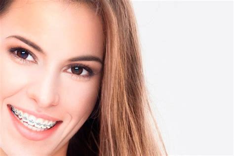 Ortodoncia Qu Tipo Es La Que Necesitas Cl Nica Dental Implantsite