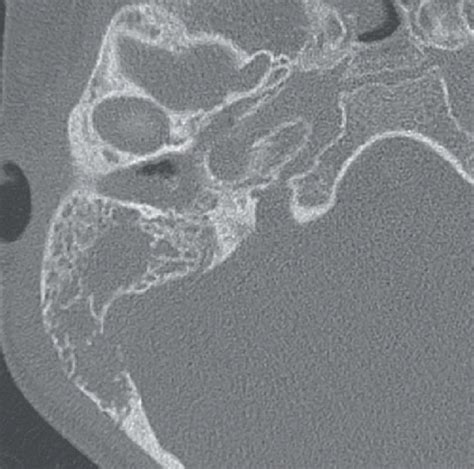 Mastoiditis Radiology Key