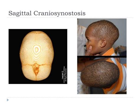 Sagittal Craniosynostosis