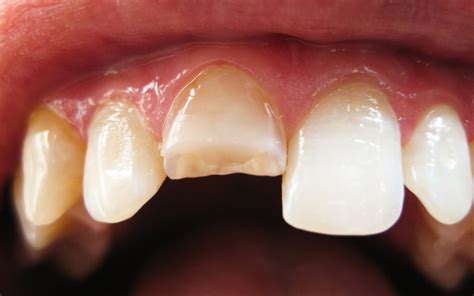 Cracked Tooth: Symptoms, Causes & Treatment - Bassedean, Perh