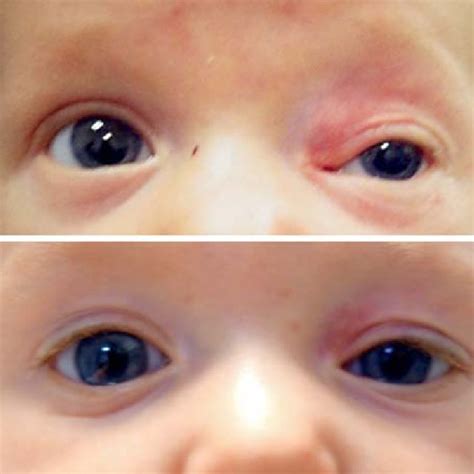 Photographs Of Case 2 A A Superficial Infantile Capillary Hemangioma