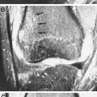 Trabecular Microfracture Follow-up MRI Data | Download Table