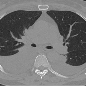 Postoperative High Resolution Chest Computed Tomogram CT Revealing