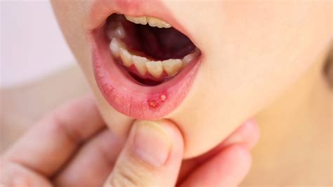 What Are Mouth Ulcers And How To Treat Them Healthmedline