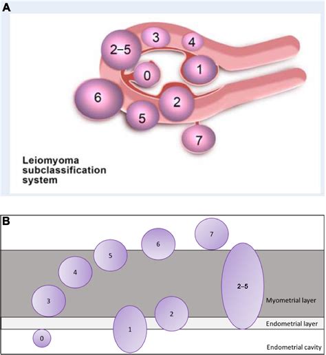 Hormone Therapy For Intramural Myoma Related Infertility From