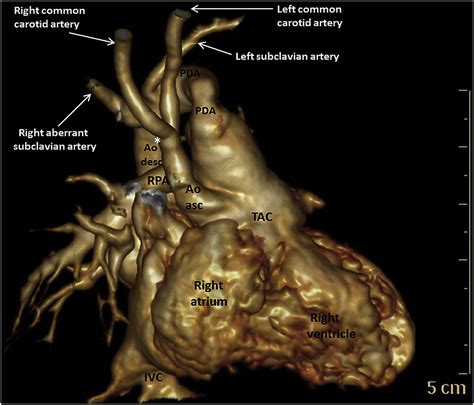 Truncus Arteriosus Communis Associated With Interrupted Aortic Arch