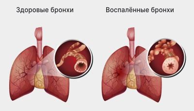 Бронхит обструктивный у взрослых симптомы и лечение