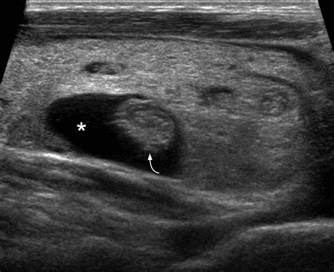 normal thyroid ultrasound