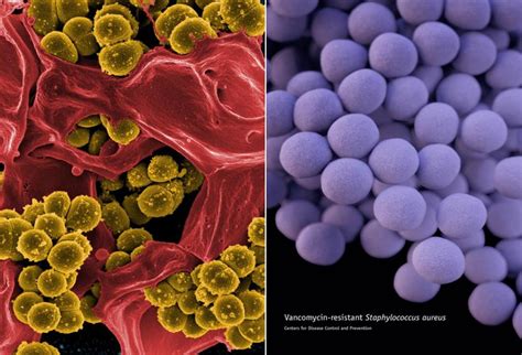 Multidrug Resistant Organisms (MDROs): Growing, Spreading, and Killing