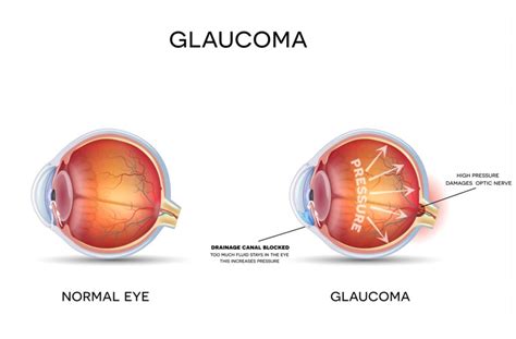 What Causes Peripheral Vision Loss Calgary Urban Optique