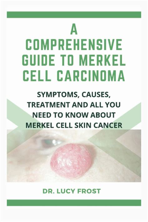 Buy A Comprehensive Guide to Merkel Cell Carcinoma: Symptoms, Causes ...