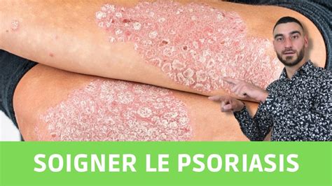 Comment Soigner Le Psoriasis Naturellement Youtube