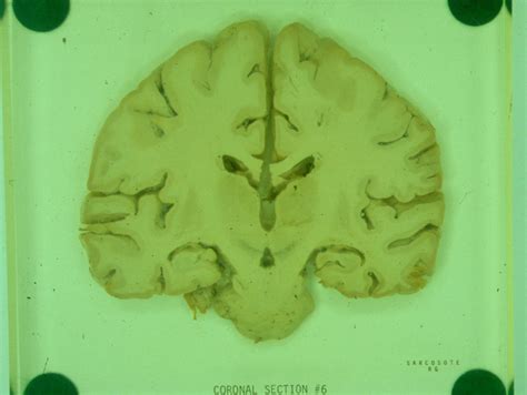 coronal 6 Diagram | Quizlet 