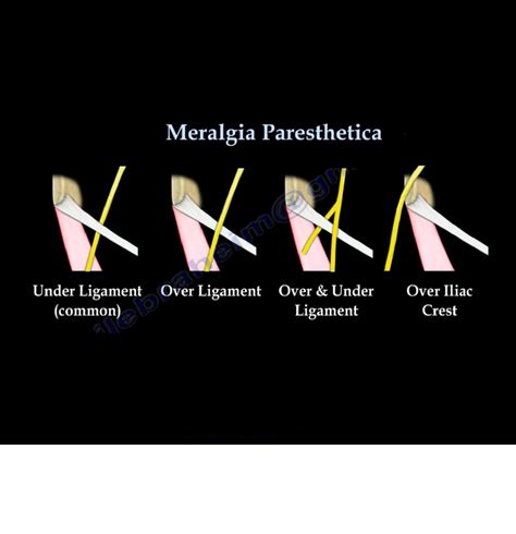 Meralgia Paresthetica — OrthopaedicPrinciples.com