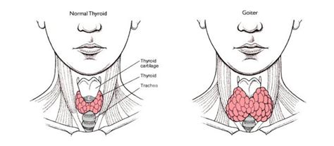 Multinodular goitre - Thyroid Sydney