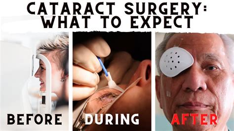 What To Expect Before During And After Cataract Surgery Youtube