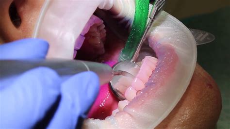 Scaling Polishing Procedure In Poldent Dental Care Cut YouTube