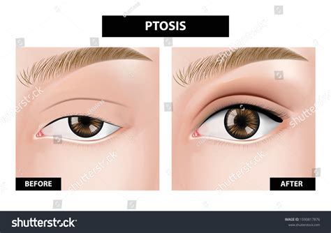 Ptosis Eyelid Before After Vector Illustration Stock Vector (Royalty ...