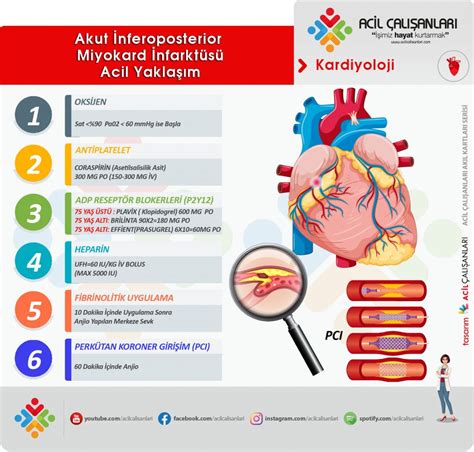 Akut İnferoposterior Miyokard İnfarktüsü Olgu Sunumu Acil Çalışanları