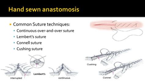 Bowel anastomosis