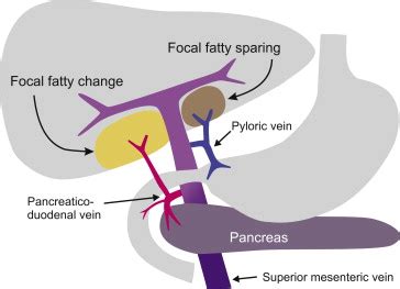 Hyperinsulinemia causes steatosis as demonstrated by these experiments ...