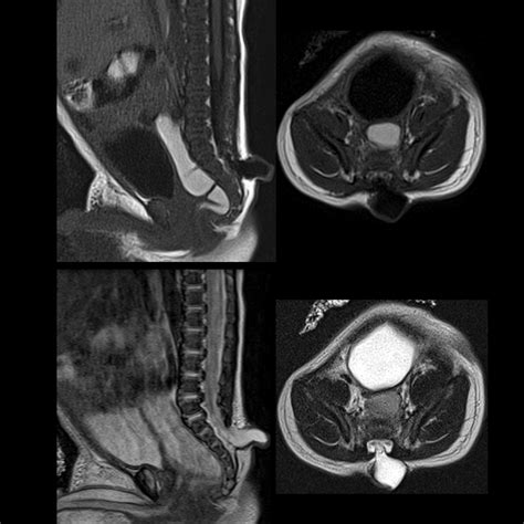 Meningocele | Pediatric Radiology Reference Article | Pediatric Imaging ...