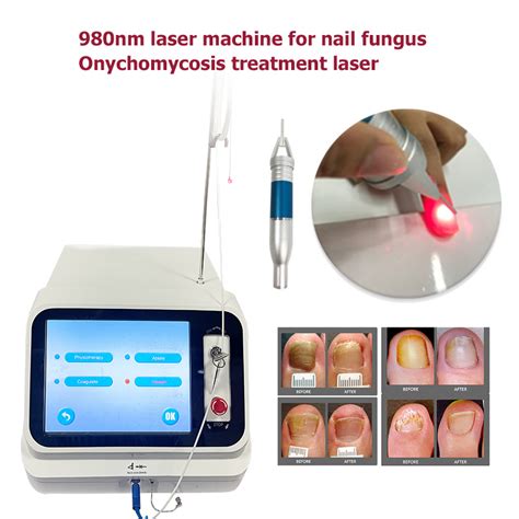 Nm Nm Dual Laser Nail Fungus Treatment Nm Laser Nail Fungus