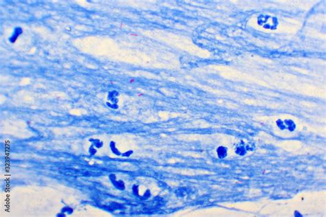 Mycobacterium Tuberculosis Positive Small Red Rod In Sputum Smear Acid Fast Stain Analyze By